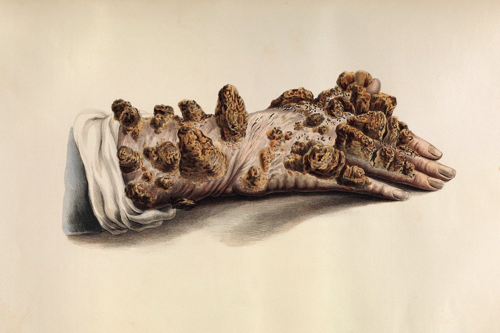 Leprosy Demonstrates How Fears of Disease Spread—and Then Live Forever | Zocalo Public Square • Arizona State University • Smithsonian