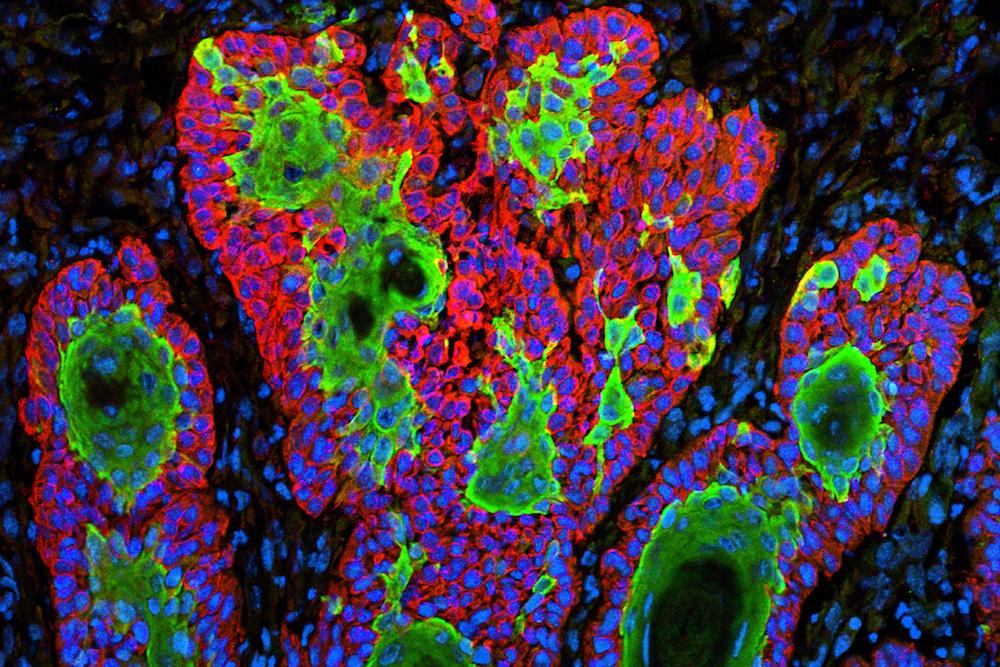 Fighting Cancer During COVID Taught Me About Our Strange Relationship With Disease | Zocalo Public Square • Arizona State University • Smithsonian